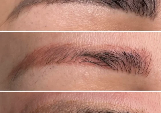 How much does it cost to get your eyebrow tattoo removed?