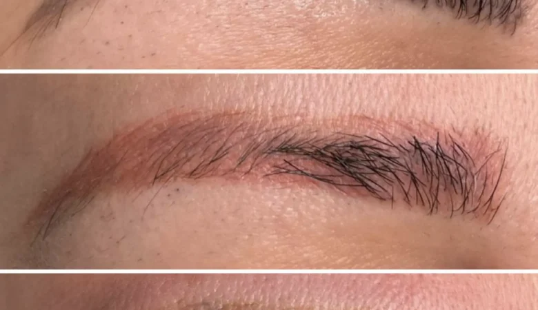 How much does it cost to get your eyebrow tattoo removed?