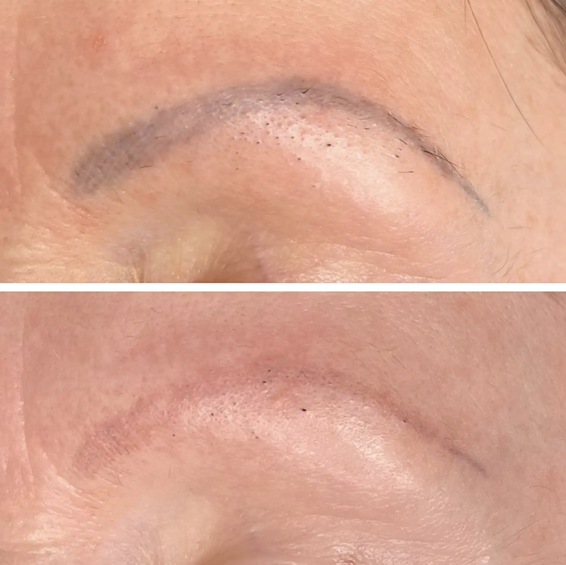 eyebrow tattoo removal cost Australia
