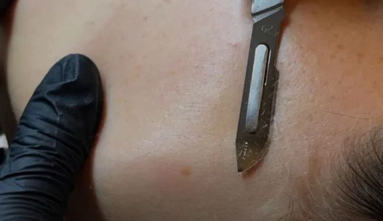 Do You Need a Certification to Perform Dermaplaning